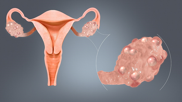 PCOS (Polycystic ovarian syndrome)