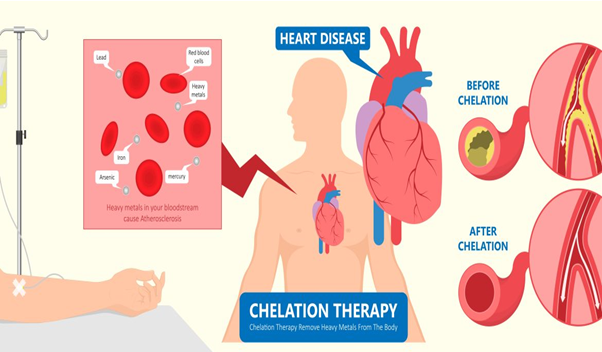 Intravenous Chelation Therapy in India